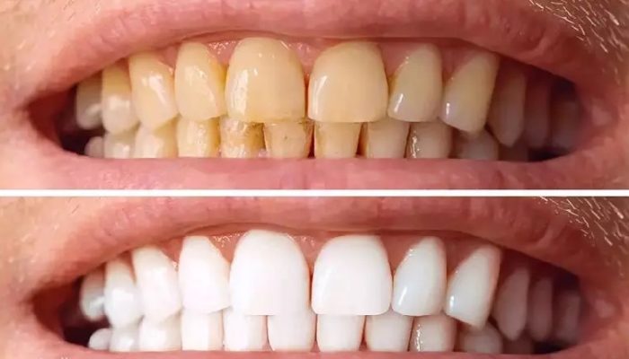 bleaching-tooth copy