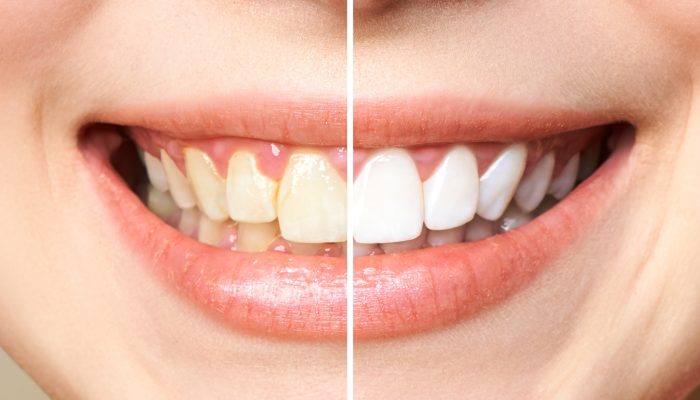 woman-teeth-before-after-whitening-image-symbolizes-stomatology_168410-885